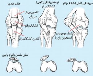 دررفتگی مادرزادی کشکک