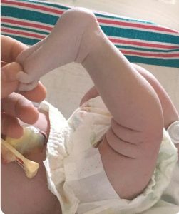 عقب زدگی زانو