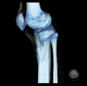 عقب زدگی زانو