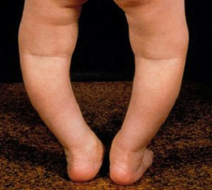 زانوی پرانتزی